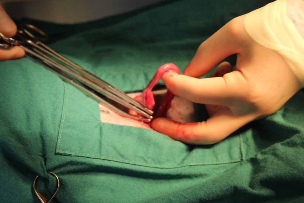 Exteriorising the ovary