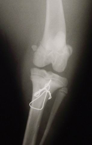 Pin and wire in tibia