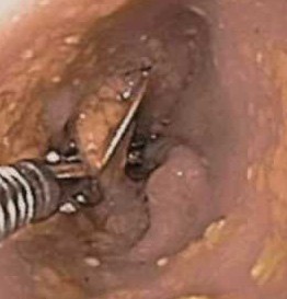 Sampling gut by biopsy