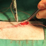 placing suture